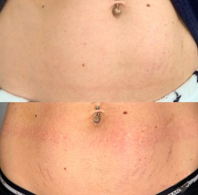 Vglow dermopigmentation réparatrice correction vergetures